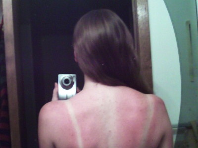 Rebekah's sunburn